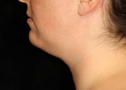 Facial Liposuction Patient Photo - Case 232 - before view-1