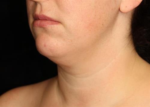Facial Liposuction Patient Photo - Case 232 - before view-2
