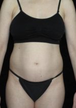 Tummy Tuck - Case 60 - Before