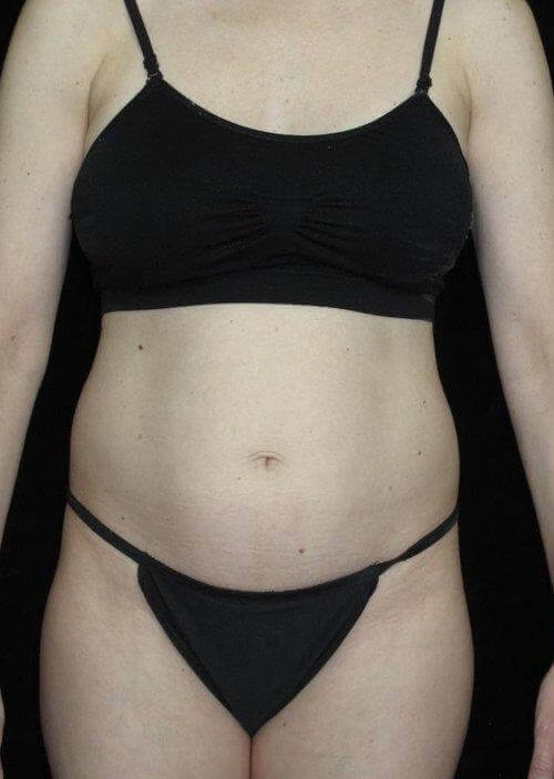 Tummy Tuck Patient Photo - Case 60 - before view-