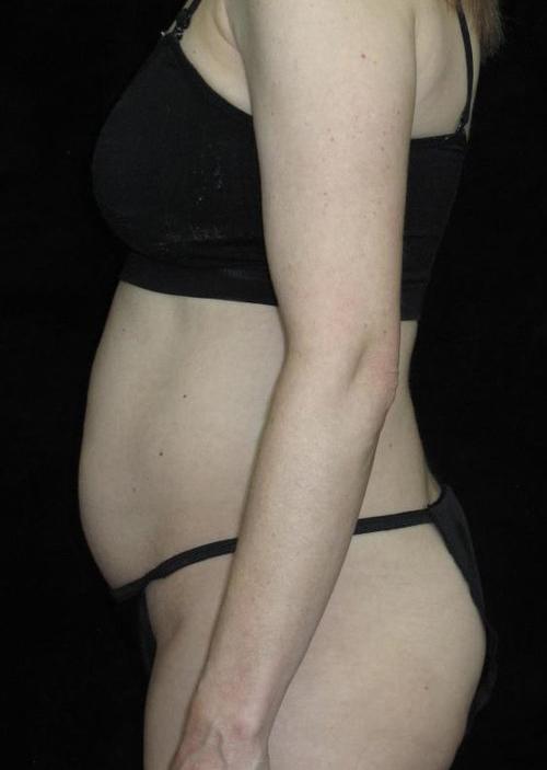 Tummy Tuck Patient Photo - Case 60 - before view-1