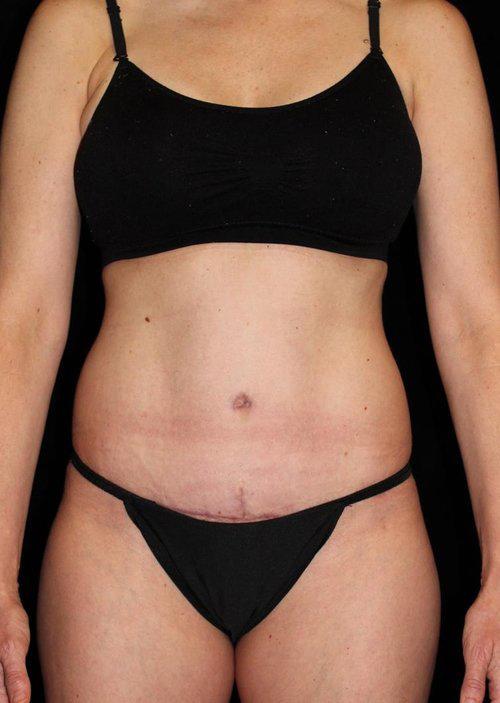 Tummy Tuck Patient Photo - Case 60 - after view-0