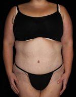 Tummy Tuck - Case 179 - After