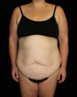 Tummy Tuck - Case 179 - Before