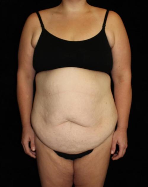 Tummy Tuck Patient Photo - Case 179 - before view-0