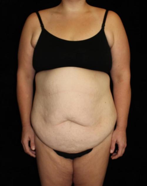 Tummy Tuck Patient Photo - Case 179 - before view-