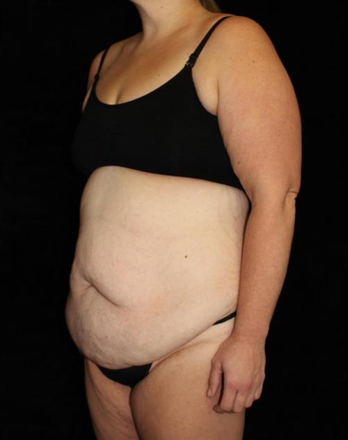 Tummy Tuck Patient Photo - Case 179 - before view-2