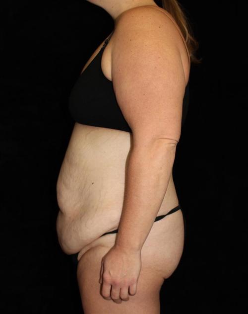 Tummy Tuck Patient Photo - Case 179 - before view-1