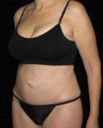 Tummy Tuck - Case 84 - After