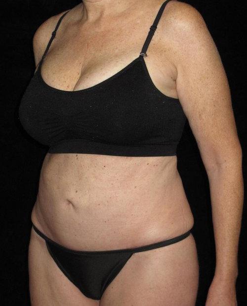 Tummy Tuck Patient Photo - Case 84 - after view