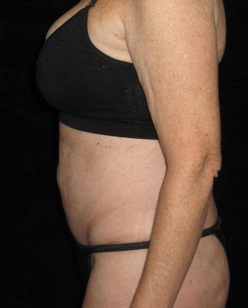 Tummy Tuck Patient Photo - Case 84 - after view-1