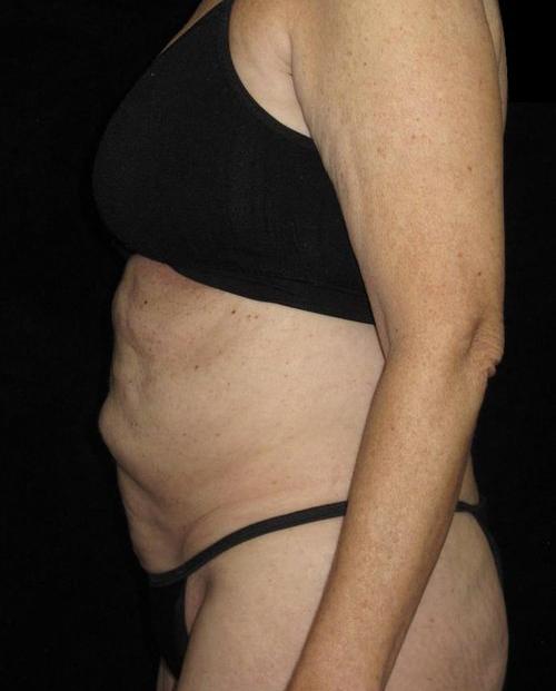 Tummy Tuck Patient Photo - Case 84 - before view-1