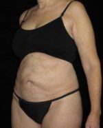 Tummy Tuck - Case 84 - Before