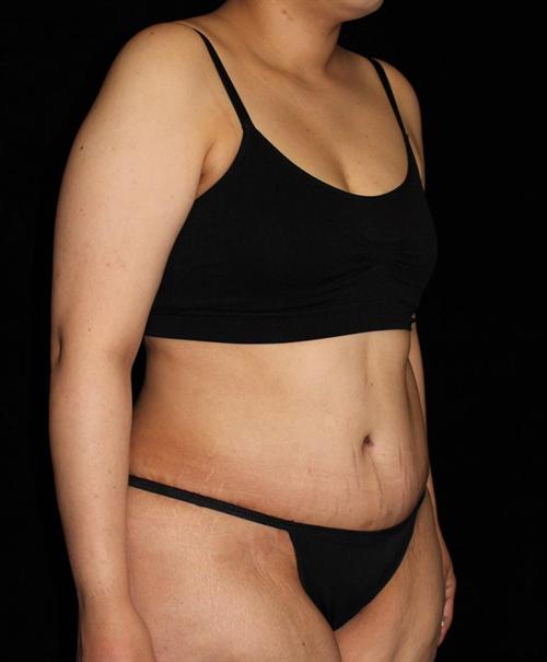 Tummy Tuck Patient Photo - Case 184 - after view-1
