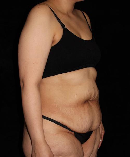 Tummy Tuck Patient Photo - Case 184 - before view-1