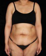 Tummy Tuck - Case 184 - Before