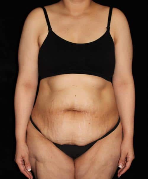 Tummy Tuck Patient Photo - Case 184 - before view-