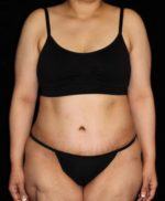 Tummy Tuck - Case 184 - After