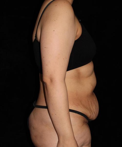 Tummy Tuck Patient Photo - Case 184 - before view-2