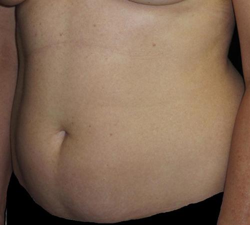 Tummy Tuck Patient Photo - Case 72 - before view-