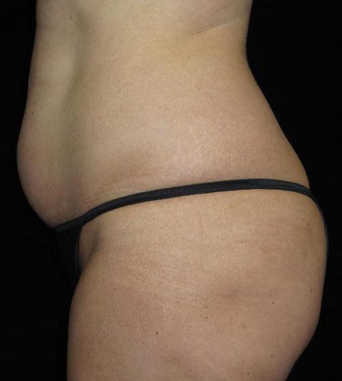 Tummy Tuck Patient Photo - Case 72 - before view-1