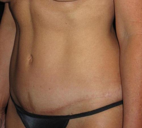 Tummy Tuck Patient Photo - Case 72 - after view