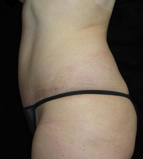 Tummy Tuck Patient Photo - Case 72 - after view-1