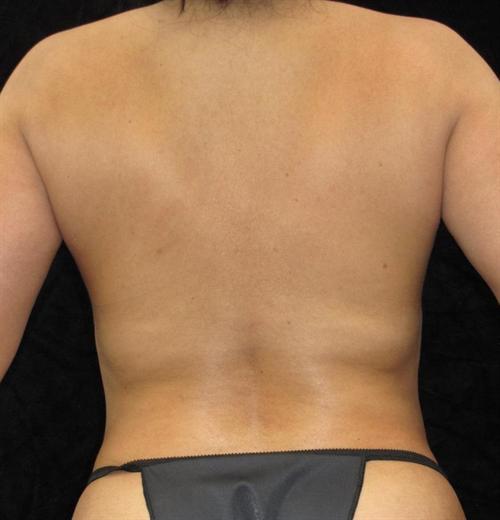 Liposuction Patient Photo - Case 61 - after view-2