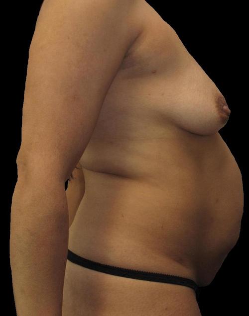 Liposuction Patient Photo - Case 61 - before view-1