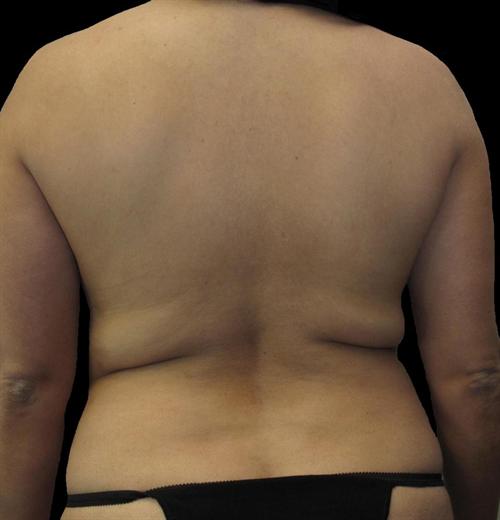 Liposuction Patient Photo - Case 61 - before view-2