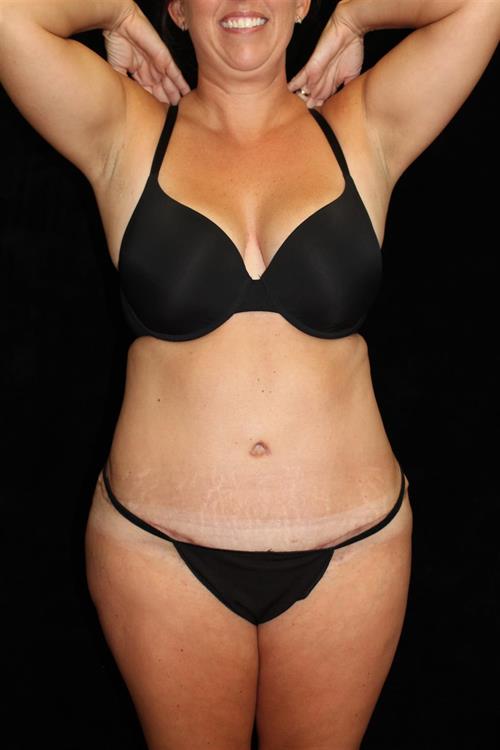 Liposuction Patient Photo - Case 216 - after view