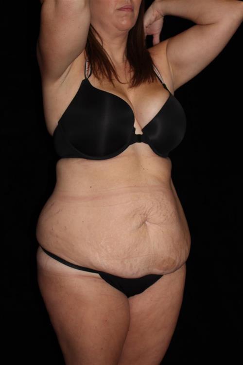 Liposuction Patient Photo - Case 216 - before view-1