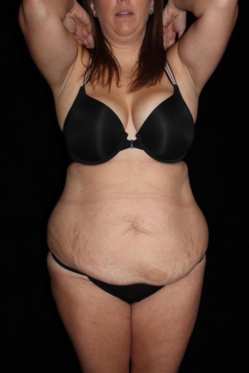 Liposuction Patient Photo - Case 216 - before view-