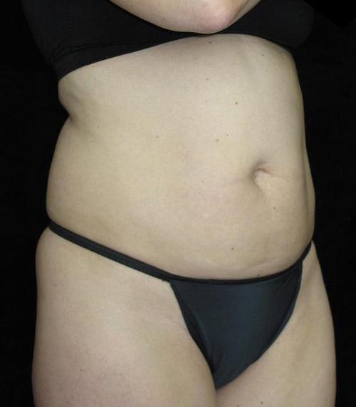 Tummy Tuck Patient Photo - Case 77 - before view-1