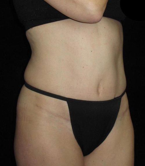 Tummy Tuck Patient Photo - Case 77 - after view-1