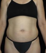 Tummy Tuck - Case 77 - Before