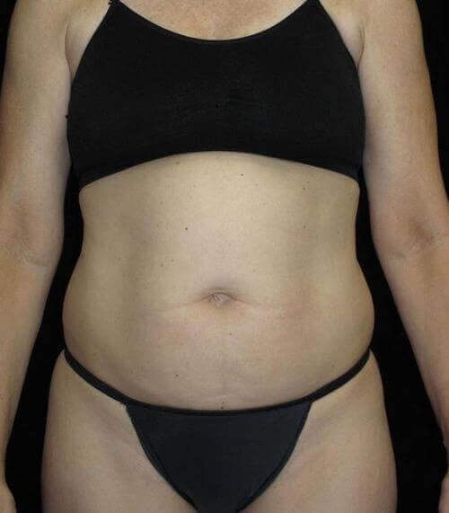 Tummy Tuck Patient Photo - Case 77 - before view-0