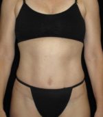 Tummy Tuck - Case 77 - After