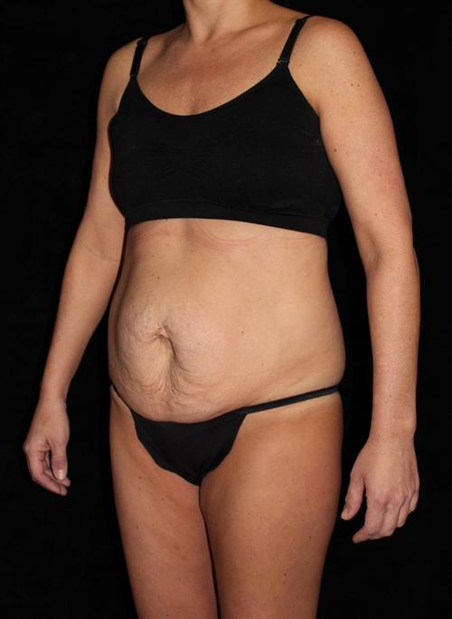 Liposuction Patient Photo - Case 183 - before view-1