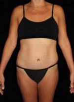 Liposuction - Case 183 - After