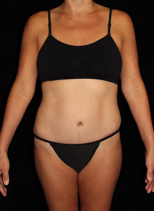 Liposuction Patient Photo - Case 183 - after view-0