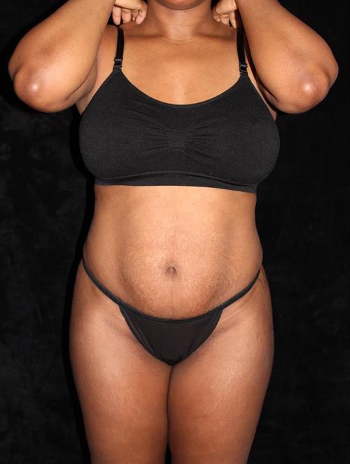 Liposuction Patient Photo - Case 219 - before view-