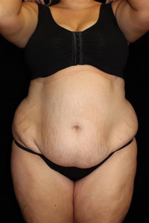 Liposuction Patient Photo - Case 217 - before view-