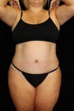 Liposuction - Case 217 - After