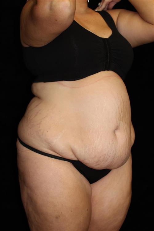 Liposuction Patient Photo - Case 217 - before view-1