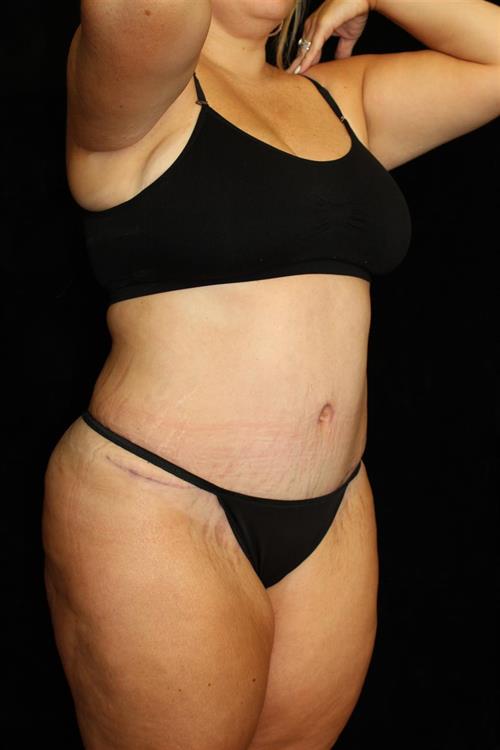 Liposuction Patient Photo - Case 217 - after view-1