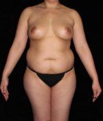 Breast lift with Augmentation - Case 227 - Before