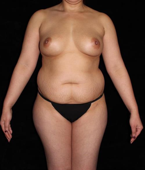 Breast lift with Augmentation Patient Photo - Case 227 - before view-