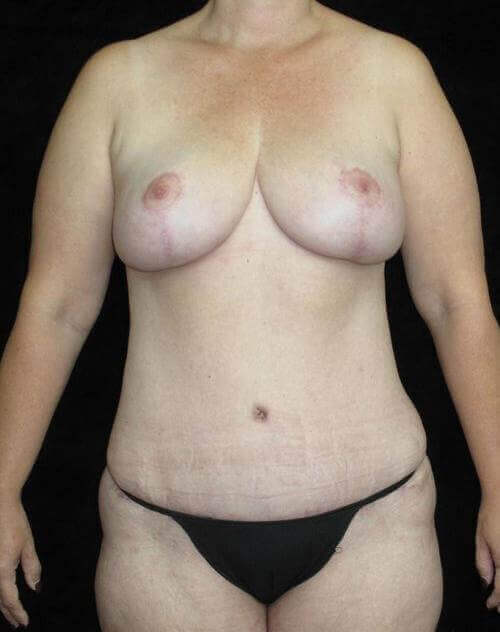 Breast lift with Augmentation Patient Photo - Case 83 - after view