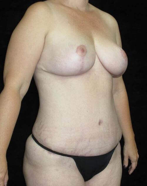 Breast lift with Augmentation Patient Photo - Case 83 - after view-1